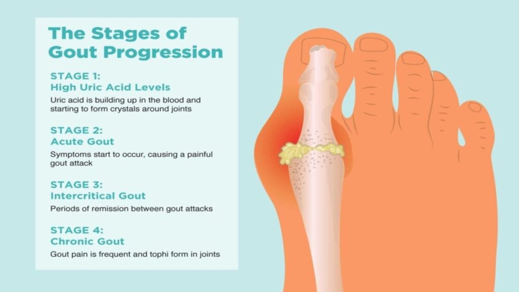 Stages Of Gout Progression and Sample Diet Plan for Gout