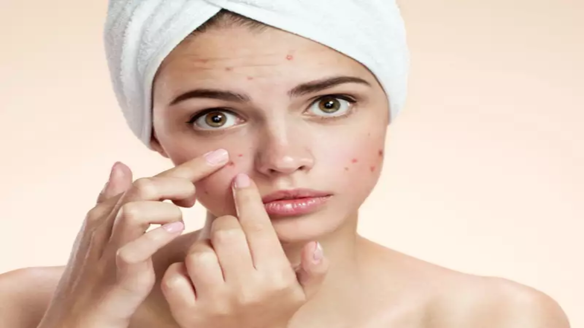 Get rid of acne