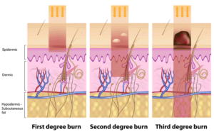 Burns - Diet Tips To Improve Healing Of Burns And General Health