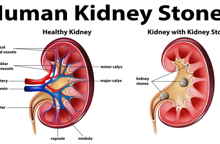 Kidney Stone Diet Management