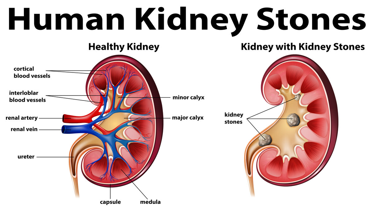 Kidney Stone Diet Management