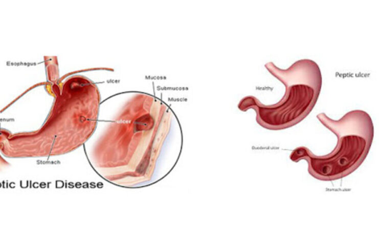 Peptic Ulcer What Foods To Eat