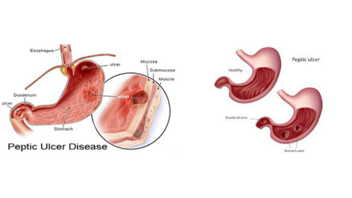 Peptic Ulcer What Foods To Eat
